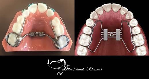 بزرگ کردن فک بالا
