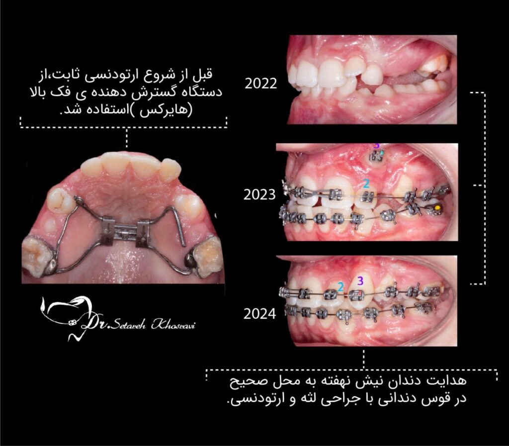 بزرگ کردن فک