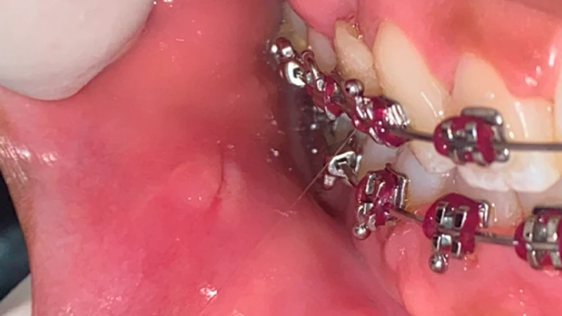 زخم شدن لب به دلیل برخورد با بریس ارتودنسی