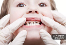پوسیدگی دندان در کودک ۵ ساله؛ از تشخیص تا درمان و پیشگیری اصولی