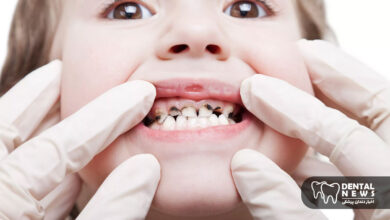 پوسیدگی دندان در کودک ۵ ساله؛ از تشخیص تا درمان و پیشگیری اصولی