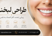 طراحی لبخند چیست؟ روش های اصطلاح طرح لبخند + مزایا و معایب
