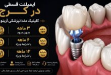 ایمپلنت دندان قسطی در کرج-آرینو