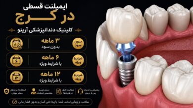 ایمپلنت دندان قسطی در کرج-آرینو