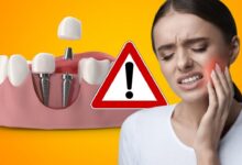 دلایل ضعف بعد از ایمپلنت دندان و یک رژیم غذایی برای پیشگیری!