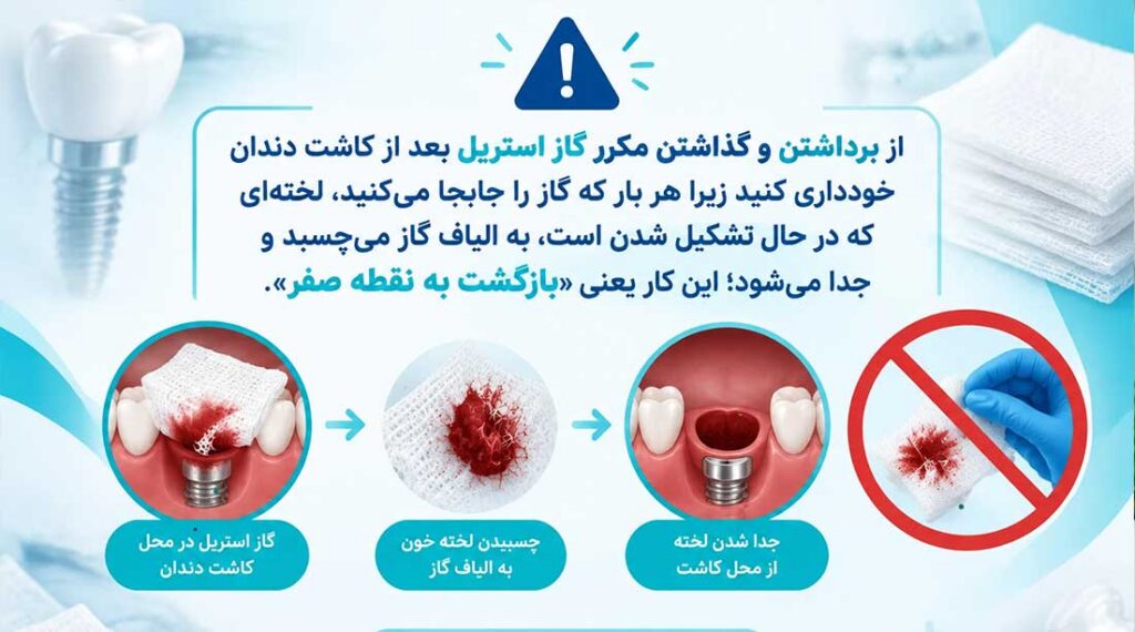 چه زمانی متوانم گاز استریل را بعد از کاشت و ایمپلنت دندان بردارم؟