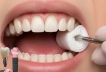 آیا بعد از ایمپلنت باید گاز استریل استفاده کرد؟ زمان استفاده و نحوه تعویض