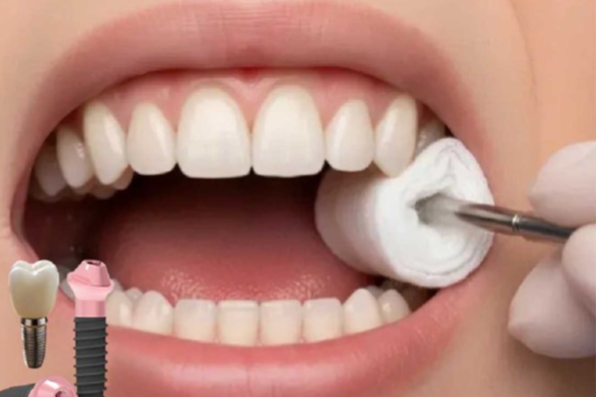 آیا بعد از ایمپلنت باید گاز استریل استفاده کرد؟ زمان استفاده و نحوه تعویض
