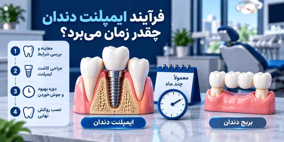 مراحل و طول درمان ایمپلنت دندان از کاشت پایه تا نصب روکش نهایی