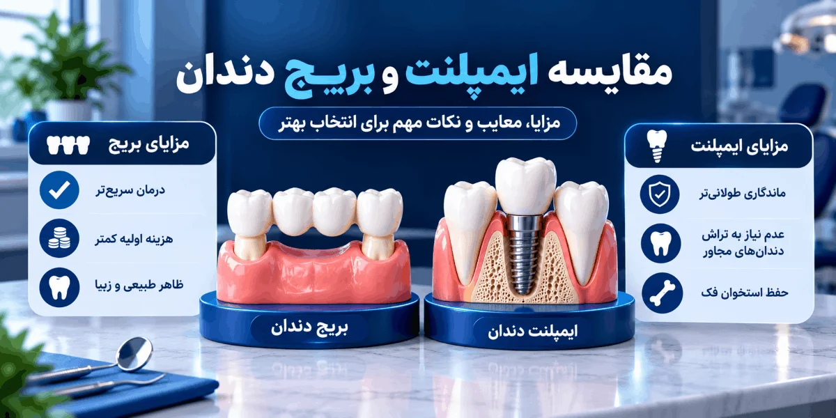 مقایسه مزایای ایمپلنت و بریج دندان از نظر دوام، حفظ استخوان و سرعت درمان