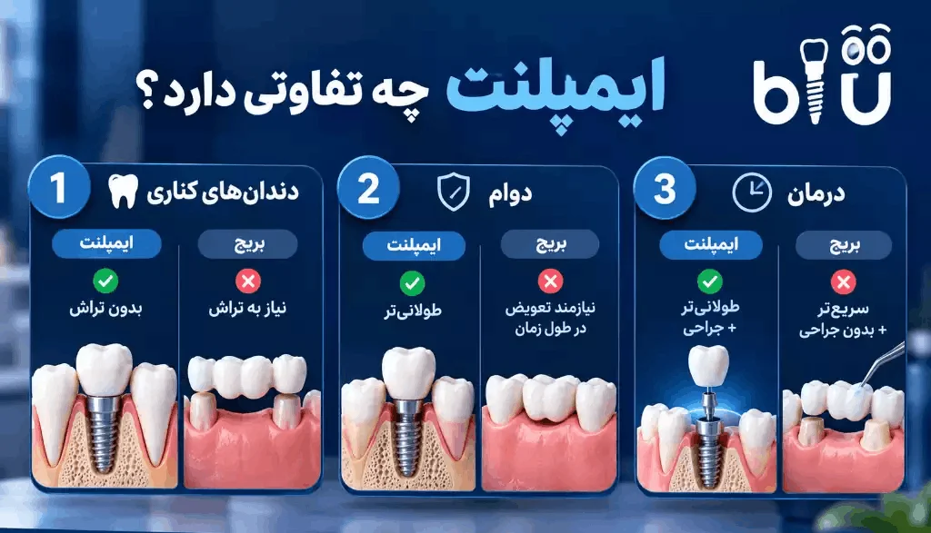 مقایسه تفاوت ایمپلنت و بریج دندان از نظر دوام، درمان و دندانهای مجاور
