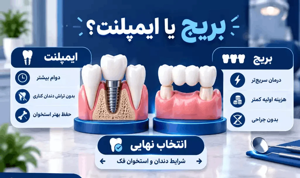 مقایسه مزایای بریج و ایمپلنت دندان برای انتخاب روش جایگزینی دندان
