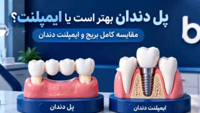 پل دندان بهتر است یا ایمپلنت؛ مقایسه بریج و ایمپلنت برای دندان از دست رفته