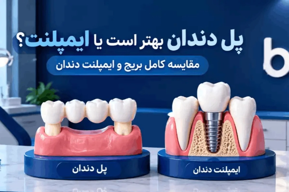 پل دندان بهتر است یا ایمپلنت؛ مقایسه بریج و ایمپلنت برای دندان از دست رفته